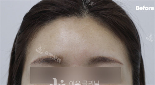 韩国Reyou皮肤科额头玻尿酸填充术前图片