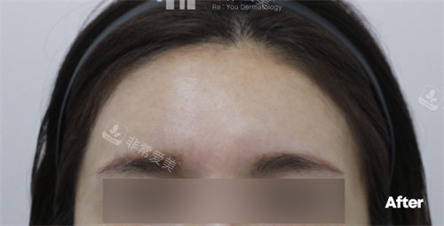 韩国Reyou皮肤科额头玻尿酸填充术后图片
