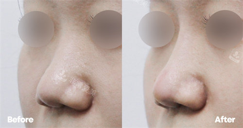 韩国Reyou皮肤科玻尿酸隆鼻侧面对比图