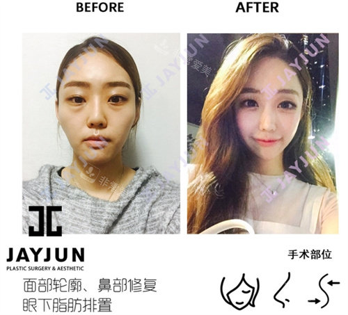 韓國jayjun整形外科手術(shù)前后對比圖 韓國jayjun整形外科手術(shù)前后對比圖