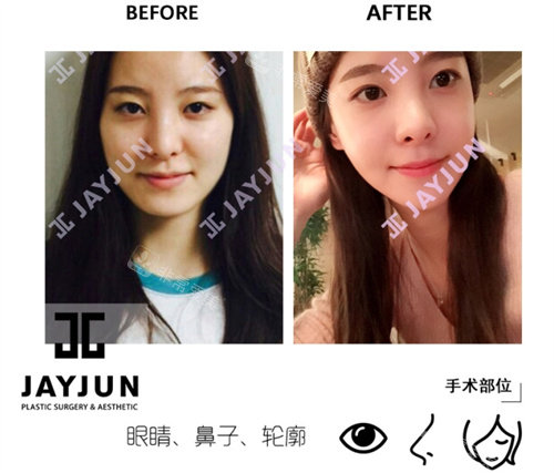 韩国jayjun整形外科手术前后对比图