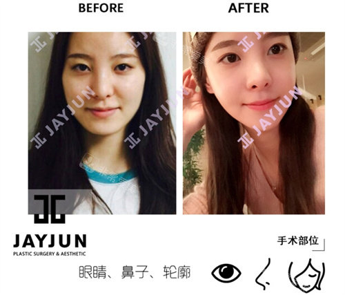 韓國jayjun整形外科手術(shù)前后對比圖 韓國jayjun整形外科手術(shù)前后對比圖
