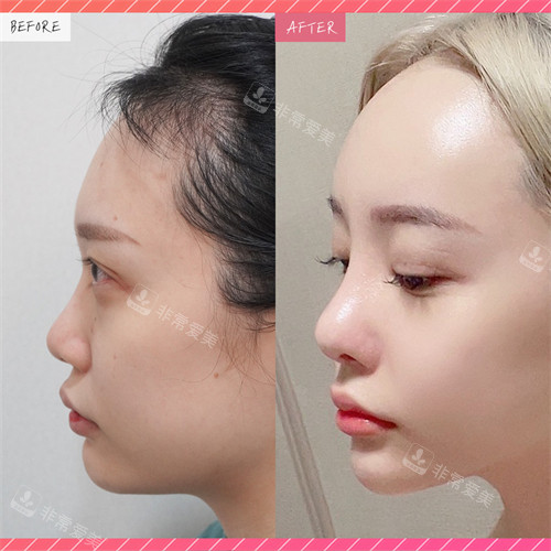 韩国美舒雅整形鼻综合手术前后对比图