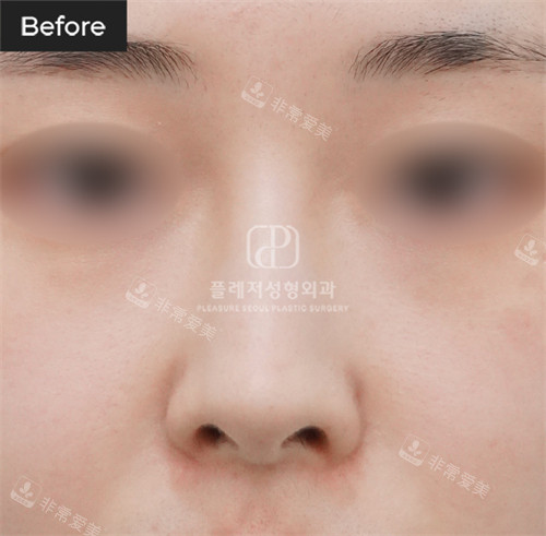 韓國褔萊澤pleasure整形外科鼻綜合前
