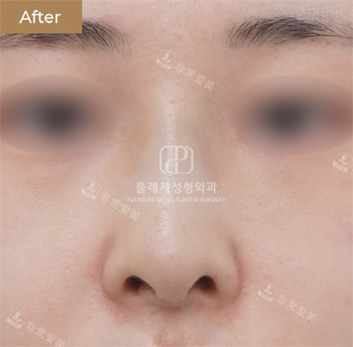 韓國褔萊澤pleasure整形外科鼻綜合后