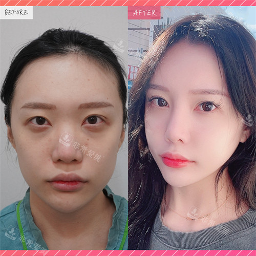 韓國美舒雅整形寬鼻矯正前后對比圖 韓國美舒雅整形寬鼻矯正前后對比圖