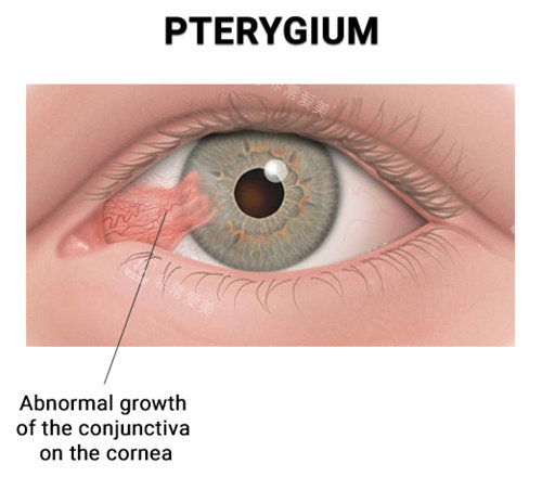 眼睛中多了一片肉（翼状胬肉）