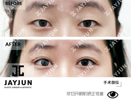 韩国jayjun整形眼部整形对比图
