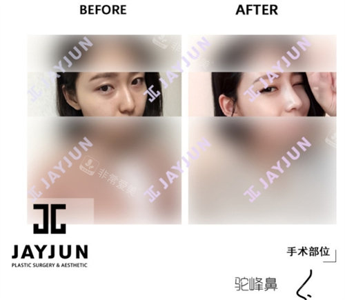 韓國jayjun整形鼻部整形對比圖 韓國jayjun整形鼻部整形對比圖
