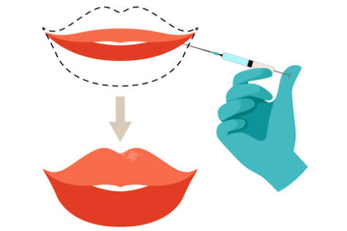 玻尿酸注射丰唇前后对比图