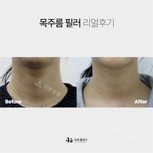 韩国Reyou皮肤科淡颈纹前后对比正面