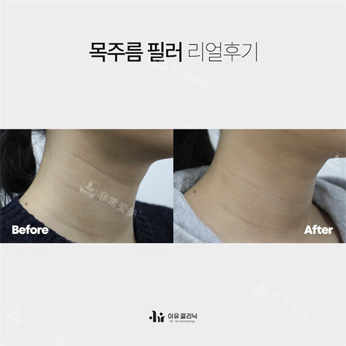 韩国Reyou皮肤科淡颈纹前后对比左侧