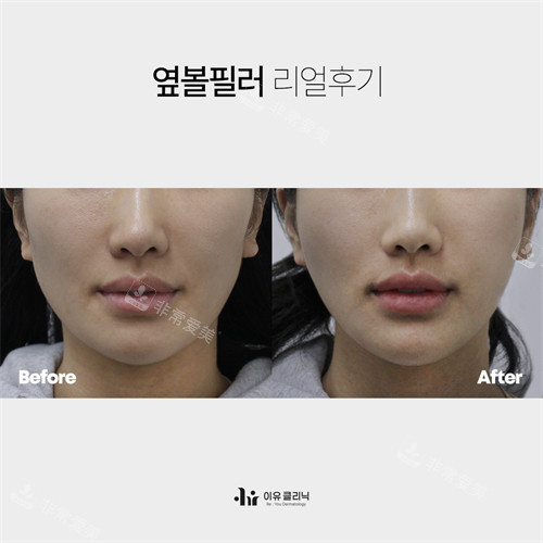 韩国Reyou皮肤面部玻尿酸填充前后对比