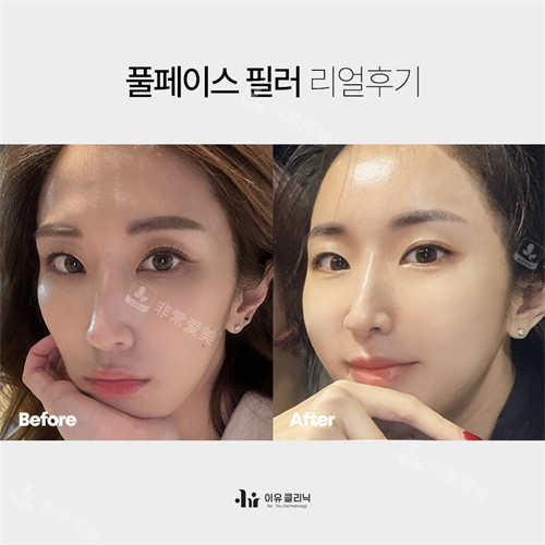 韩国Reyou皮肤科面部玻尿酸填充前后对比图
