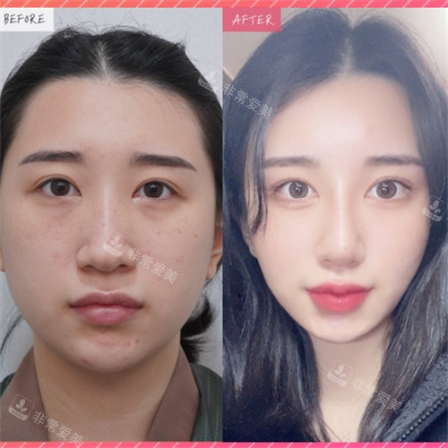 韩国美舒雅整形外科隆鼻对比图
