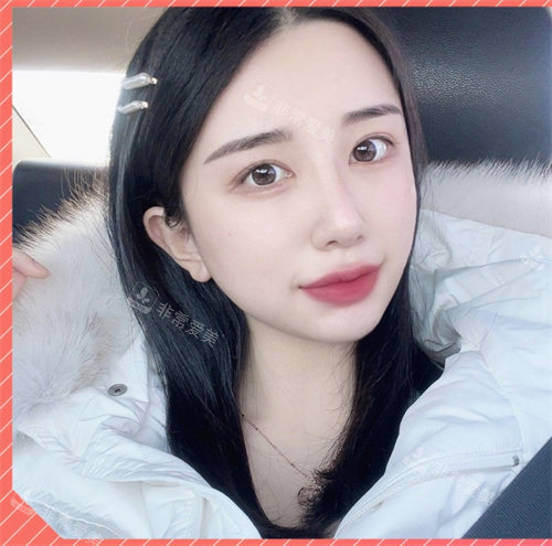韩国美舒雅整形外科隆鼻术后图