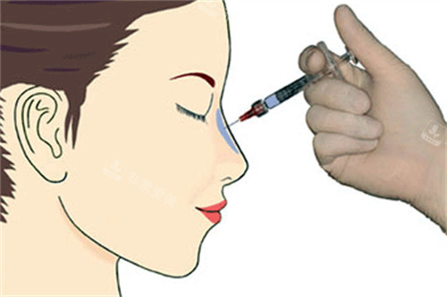注射增高鼻梁的过程