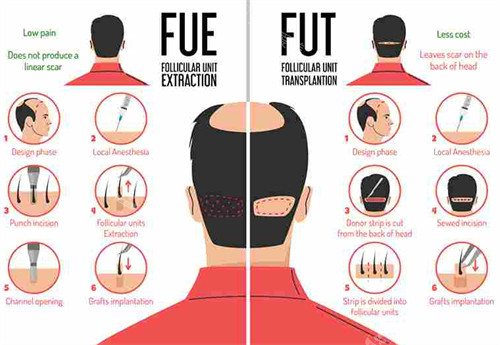 植发手术方式对比