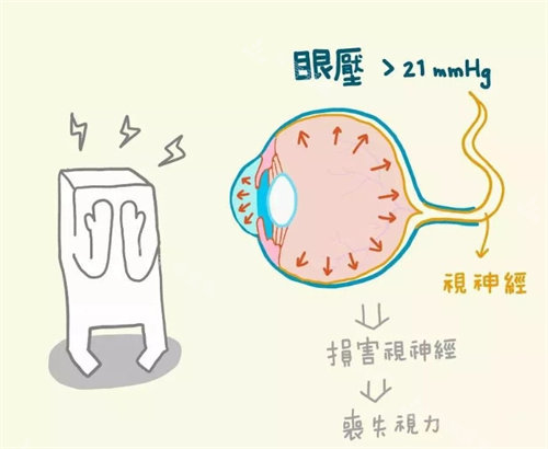 青光眼手术示意图