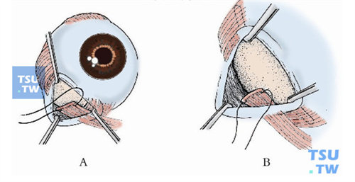 斜视手术示意图