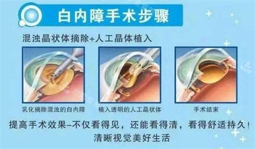 白内障手术示意图