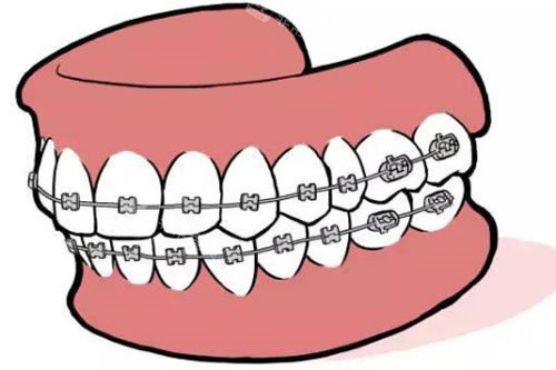 牙齿矫正示意图