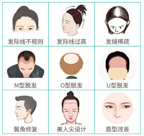 不同脱发情况展示图