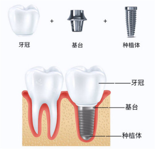 种植牙组成结构图