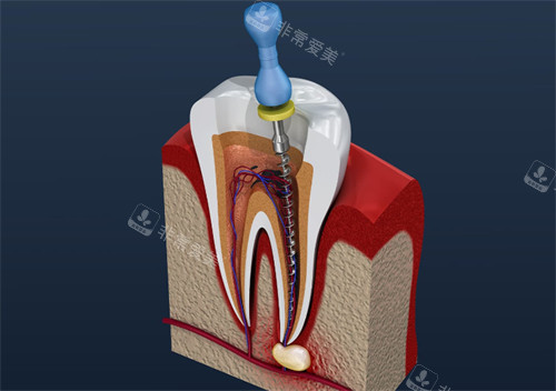 进行根管治疗的牙齿