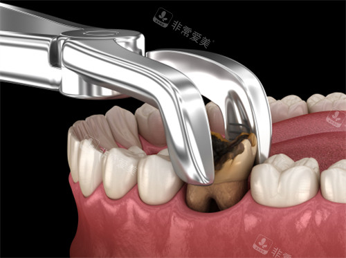 拔掉龋坏的牙齿示意图