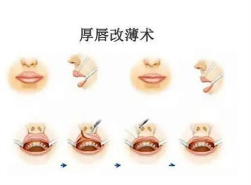 缩唇术的手术过程图解