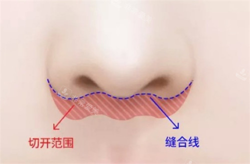 人中缩短术切开的位置图解