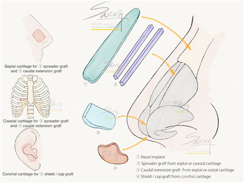 鼻整形材料图示
