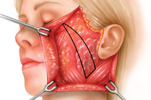 大拉皮手术面部剥离的样子