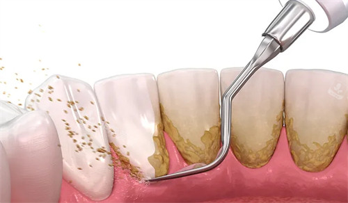 清洗牙齿上附着的牙菌斑牙结石等