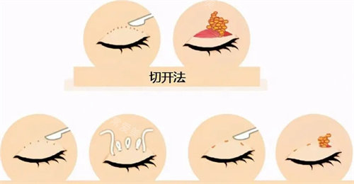 雙眼皮手術流程圖 雙眼皮手術流程圖