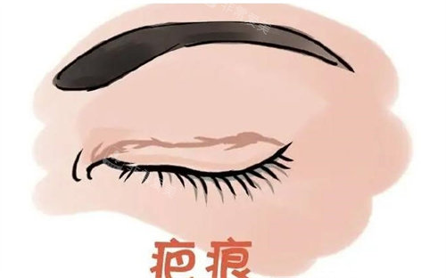 雙眼皮疤痕動畫圖 雙眼皮疤痕動畫圖
