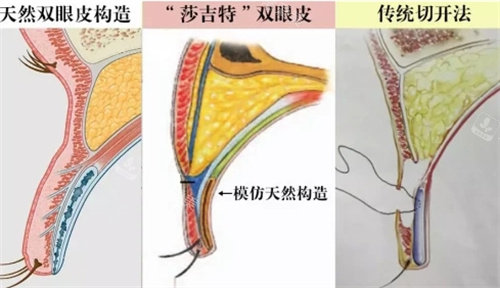 三种不同双眼皮操作方法