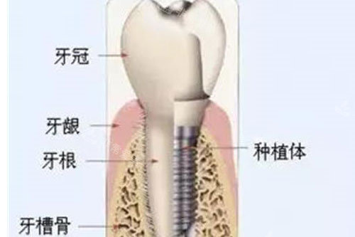 种植牙组成示意图