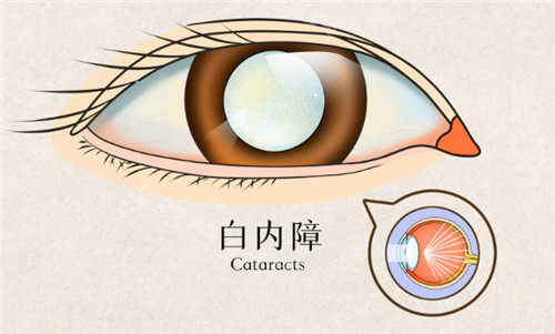 白内障手术图片