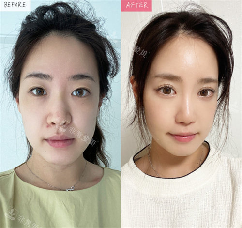 韩国褔莱泽pleasure整形外科做鼻子正面前后对比图