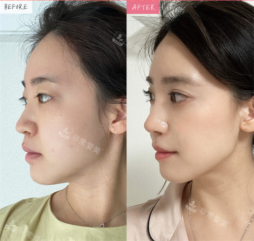 韓國美舒雅整形做鼻子側(cè)面前后對比
