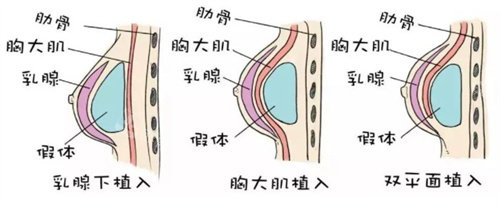 假体放置位置