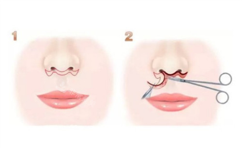 人中縮短術(shù)手術(shù)過程圖解 人中縮短術(shù)手術(shù)過程圖解