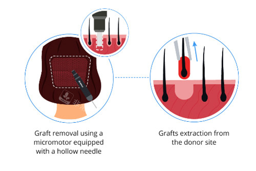 植发过程图解