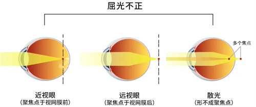 屈光不正的三种情况