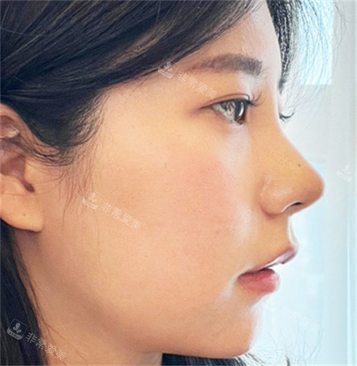 隆鼻后圖 隆鼻后圖