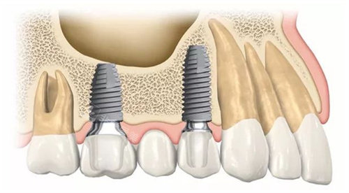 种植牙动画图