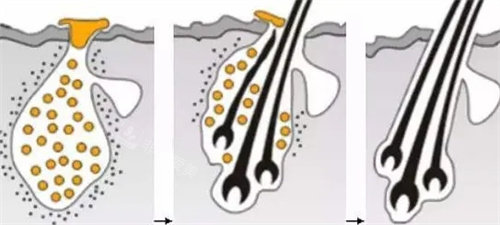 蛋白纤维植发过程图