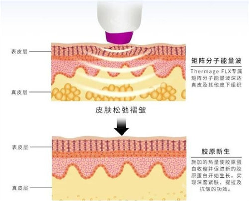 热玛吉工作原理展示图